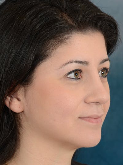 Rhinoplasty Before & After Gallery - Patient 148072003 - Image 8