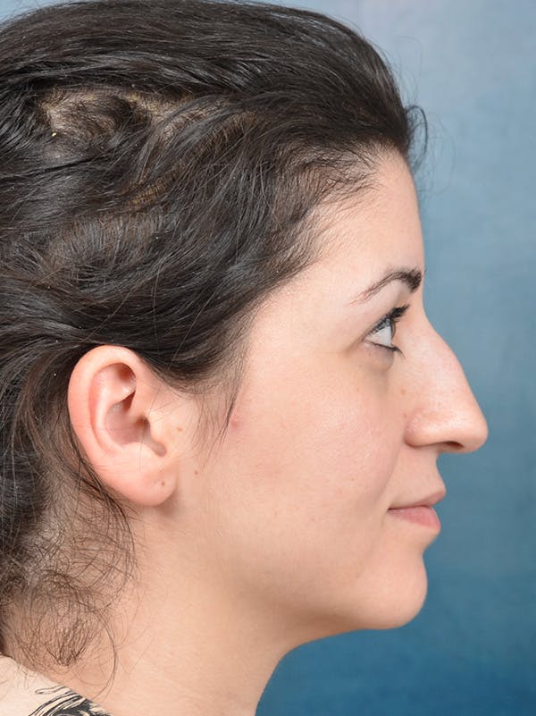 Rhinoplasty Before & After Gallery - Patient 148072003 - Image 9