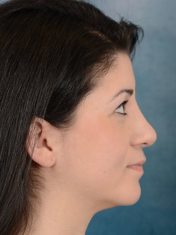 Rhinoplasty Before & After Gallery - Patient 148072003 - Image 10