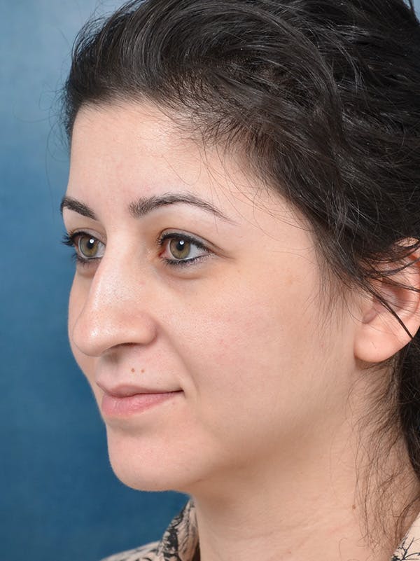 Rhinoplasty Before & After Gallery - Patient 148072003 - Image 3
