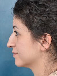 Rhinoplasty Before & After Gallery - Patient 148072003 - Image 1