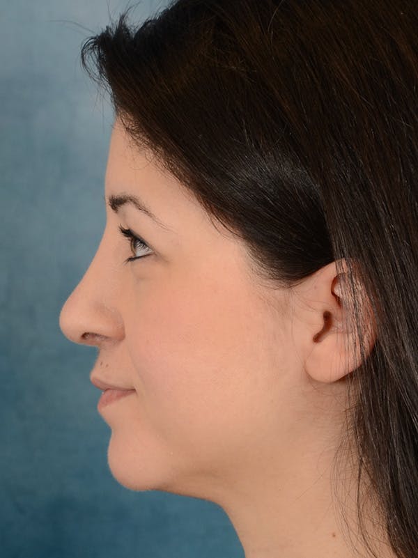 Rhinoplasty Before & After Gallery - Patient 148072003 - Image 2