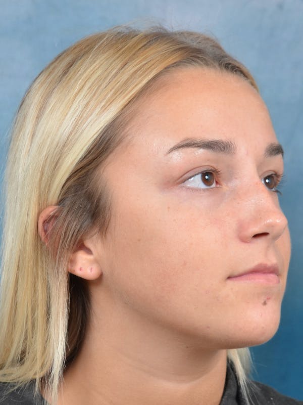 Rhinoplasty Before & After Gallery - Patient 148072041 - Image 7