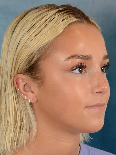 Rhinoplasty Before & After Gallery - Patient 148072041 - Image 8