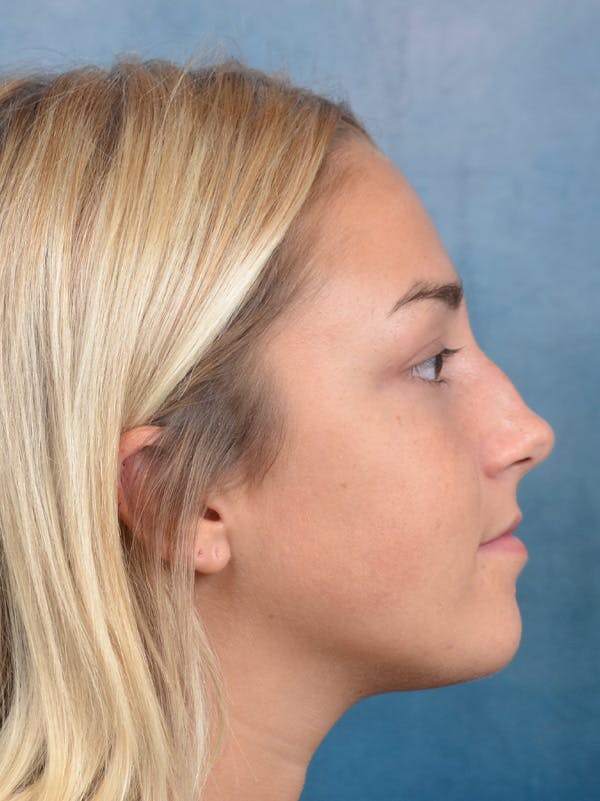 Rhinoplasty Before & After Gallery - Patient 148072041 - Image 9
