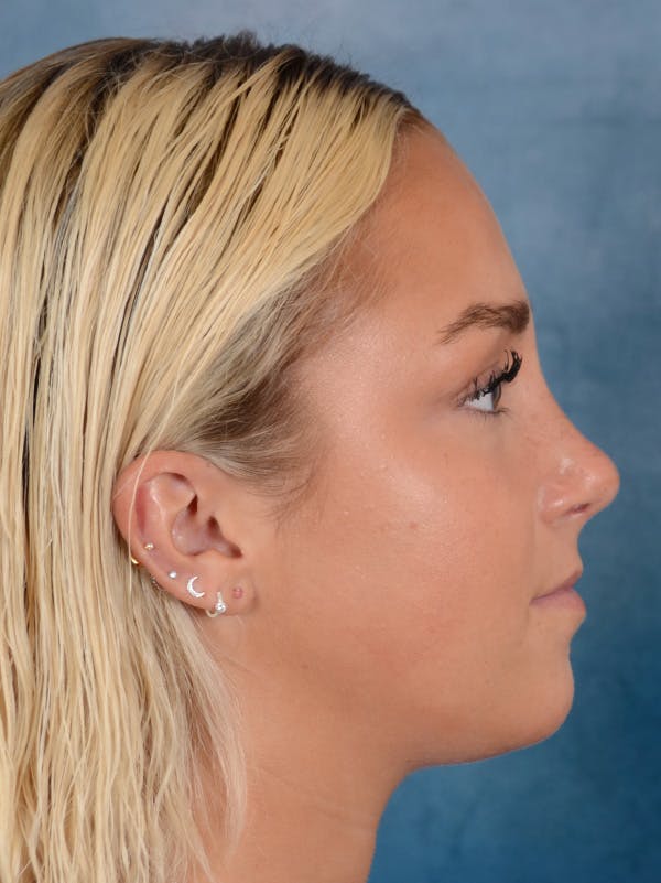 Rhinoplasty Before & After Gallery - Patient 148072041 - Image 10