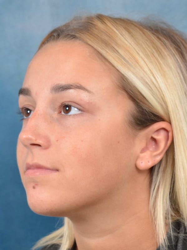 Rhinoplasty Before & After Gallery - Patient 148072041 - Image 3