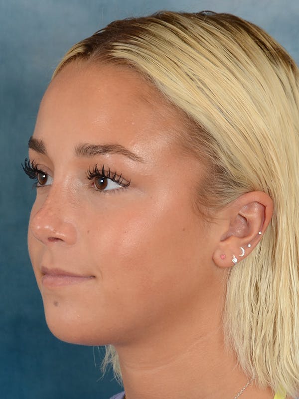 Rhinoplasty Before & After Gallery - Patient 148072041 - Image 4