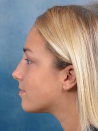 Rhinoplasty Before & After Gallery - Patient 148072041 - Image 1