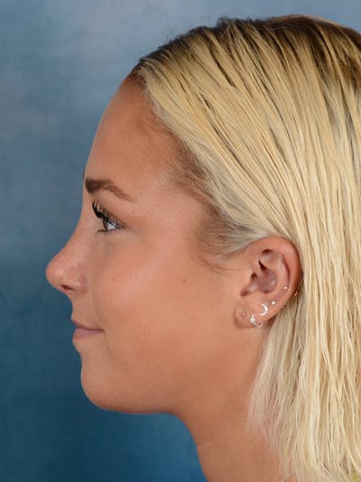 Rhinoplasty Before & After Gallery - Patient 148072041 - Image 2