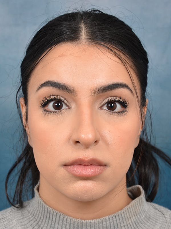 Rhinoplasty Before & After Gallery - Patient 148257032 - Image 5