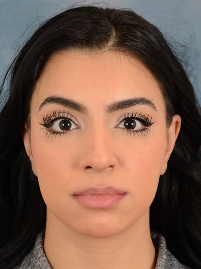 Rhinoplasty Before & After Gallery - Patient 148257032 - Image 6