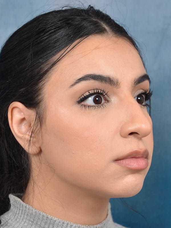 Rhinoplasty Before & After Gallery - Patient 148257032 - Image 7