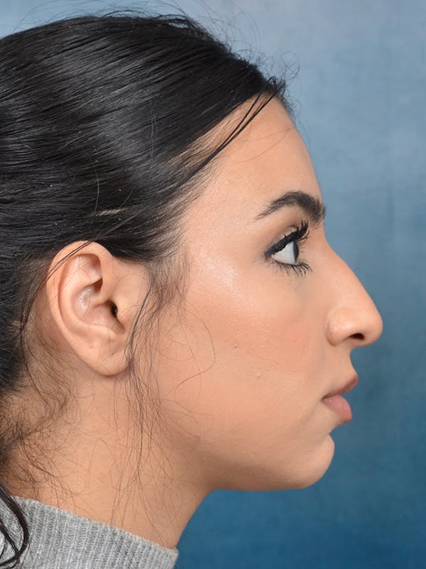 Rhinoplasty Before & After Gallery - Patient 148257032 - Image 9