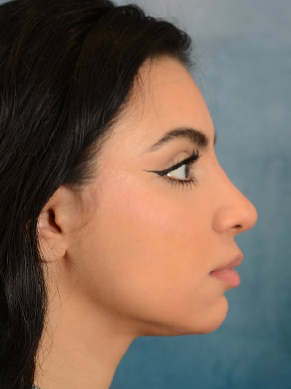 Rhinoplasty Before & After Gallery - Patient 148257032 - Image 10