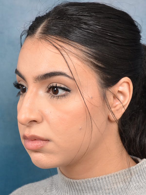 Rhinoplasty Before & After Gallery - Patient 148257032 - Image 3