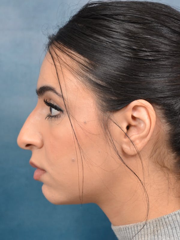 Rhinoplasty Before & After Gallery - Patient 148257032 - Image 1