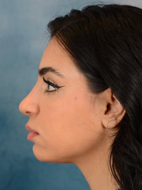 Rhinoplasty Before & After Gallery - Patient 148257032 - Image 2
