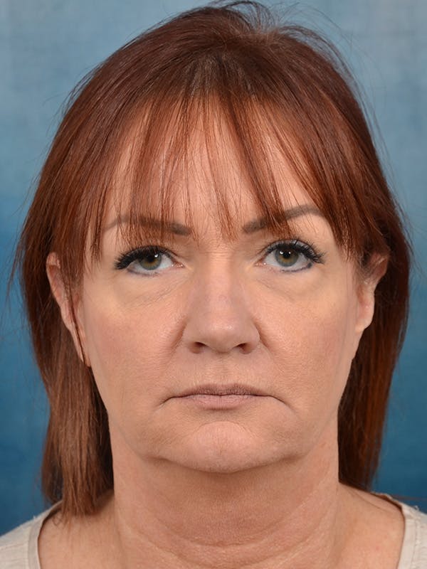 Deep Plane Facelift Before & After Gallery - Patient 148257053 - Image 3