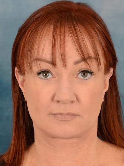 Deep Plane Facelift Before & After Gallery - Patient 148257053 - Image 4