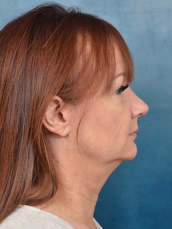 Laser Skin Resurfacing Before & After Gallery - Patient 148072053 - Image 7