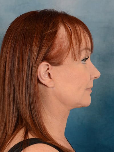 Deep Plane Facelift Before & After Gallery - Patient 148257053 - Image 8