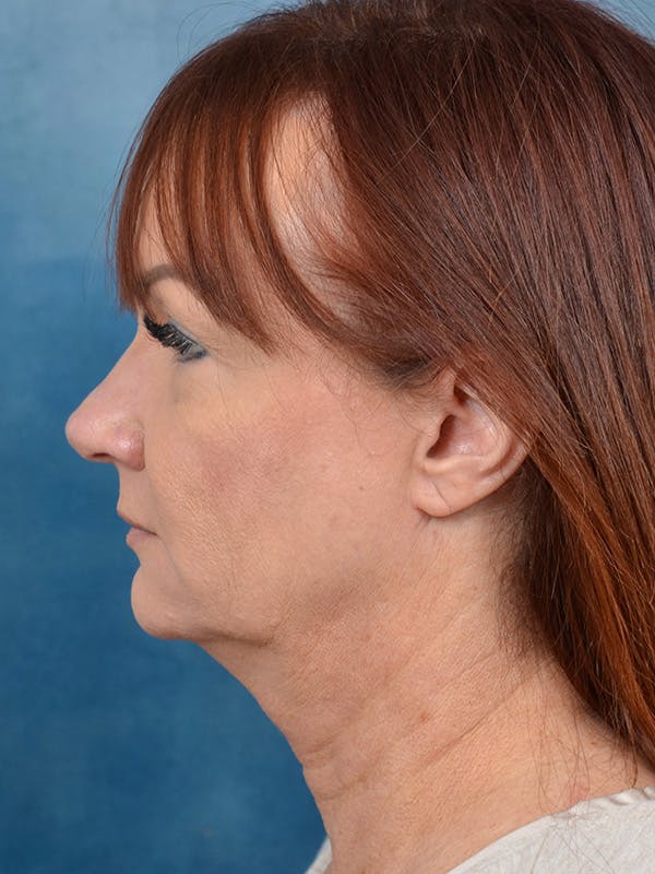 Laser Skin Resurfacing Before & After Gallery - Patient 148072053 - Image 9