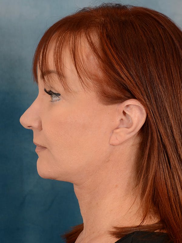 Deep Plane Facelift Before & After Gallery - Patient 148257053 - Image 10