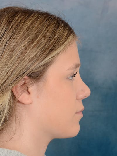 Rhinoplasty Before & After Gallery - Patient 148257033 - Image 8
