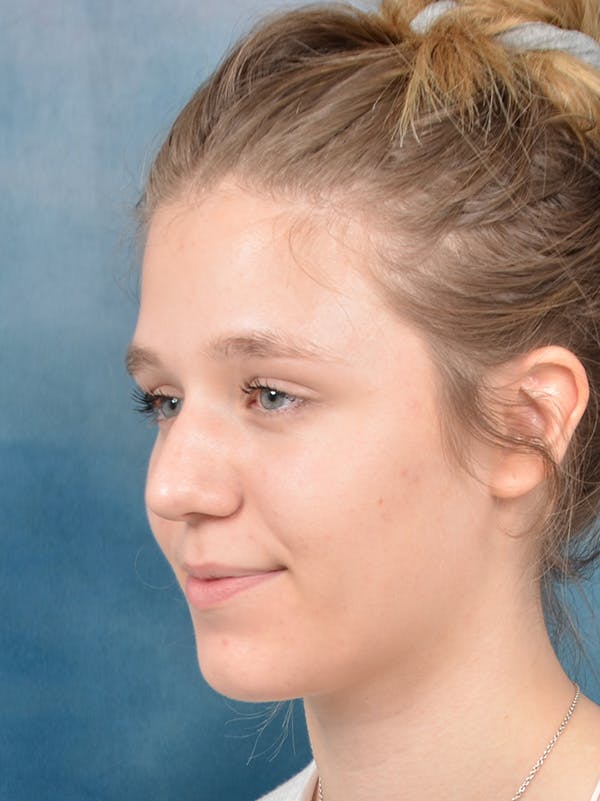 Rhinoplasty Before & After Gallery - Patient 148257033 - Image 9