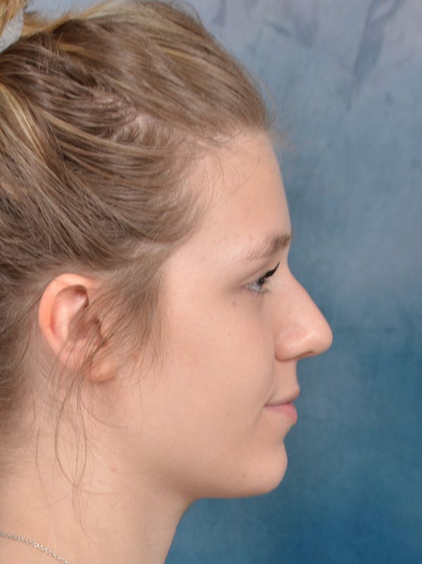 Rhinoplasty Before & After Gallery - Patient 148257033 - Image 7
