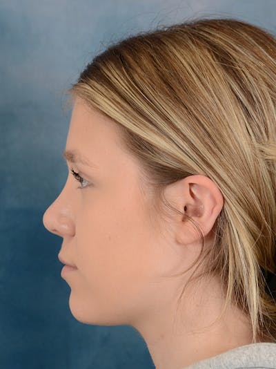 Rhinoplasty Before & After Gallery - Patient 148257033 - Image 2