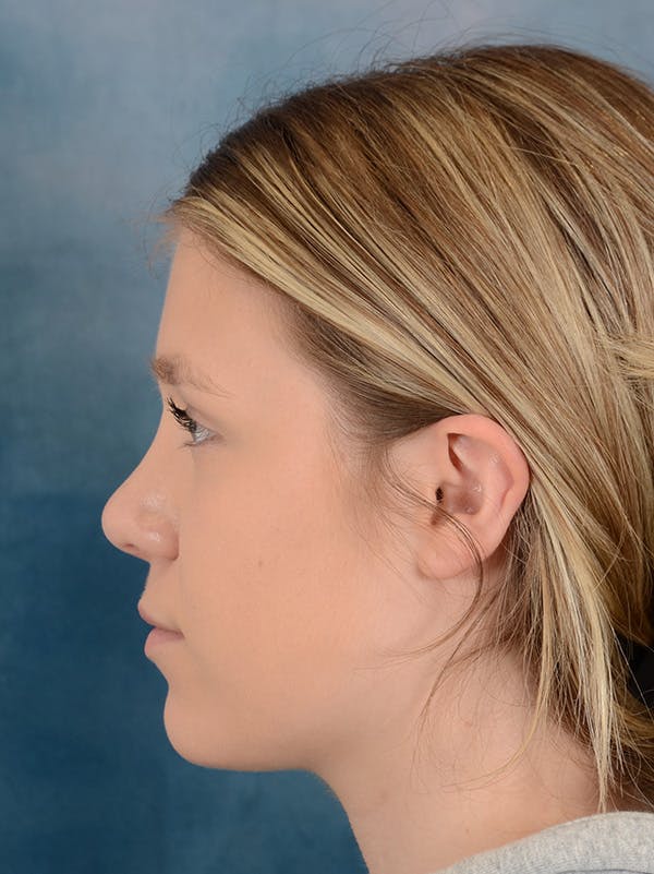 Rhinoplasty Before & After Gallery - Patient 148257033 - Image 2