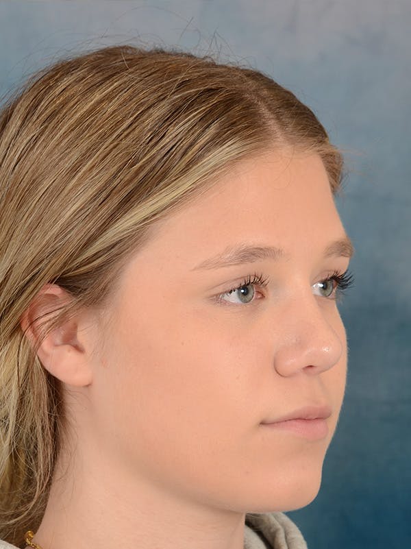 Rhinoplasty Before & After Gallery - Patient 148257033 - Image 6