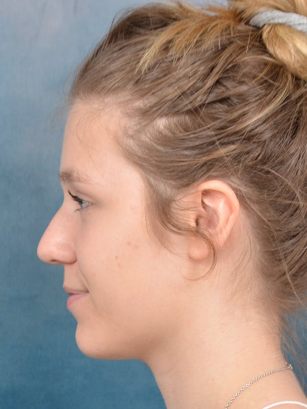 Rhinoplasty Before & After Gallery - Patient 148257033 - Image 1