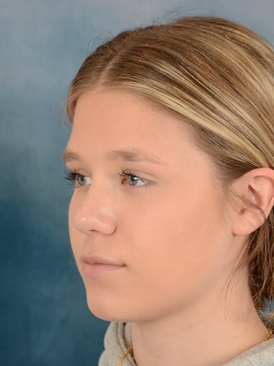 Rhinoplasty Before & After Gallery - Patient 148257033 - Image 10