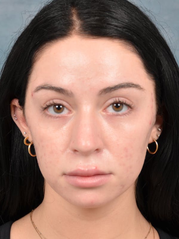 Rhinoplasty Before & After Gallery - Patient 148257034 - Image 3