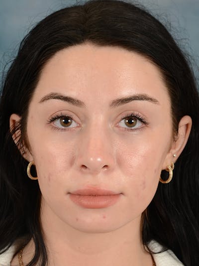 Rhinoplasty Before & After Gallery - Patient 148257034 - Image 4