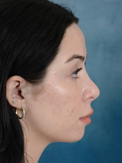 Rhinoplasty Before & After Gallery - Patient 148257034 - Image 8