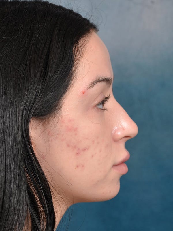 Rhinoplasty Before & After Gallery - Patient 148257034 - Image 7