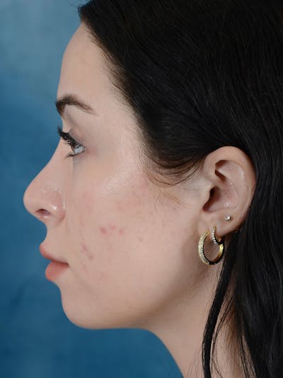 Rhinoplasty Before & After Gallery - Patient 148257034 - Image 2