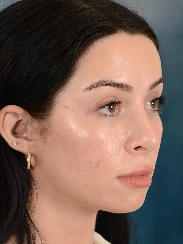 Rhinoplasty Before & After Gallery - Patient 148257034 - Image 6