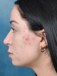 Rhinoplasty Before & After Gallery - Patient 148257034 - Image 1
