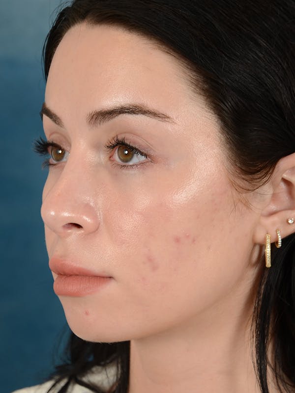 Rhinoplasty Before & After Gallery - Patient 148257034 - Image 10