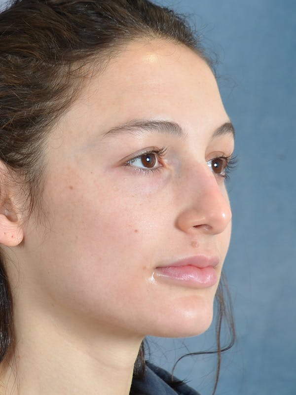 Rhinoplasty Before & After Gallery - Patient 148257069 - Image 5