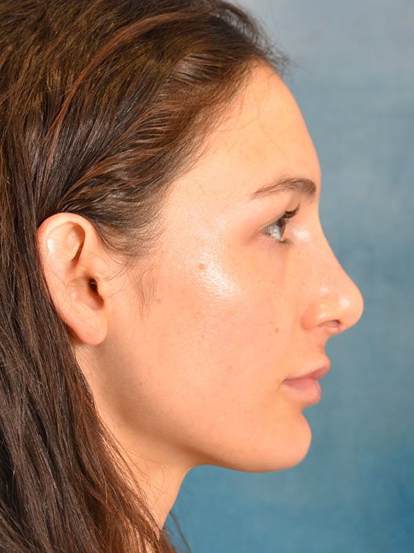 Rhinoplasty Before & After Gallery - Patient 148257069 - Image 8