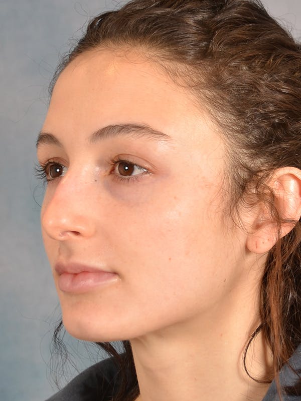 Rhinoplasty Before & After Gallery - Patient 148257069 - Image 9