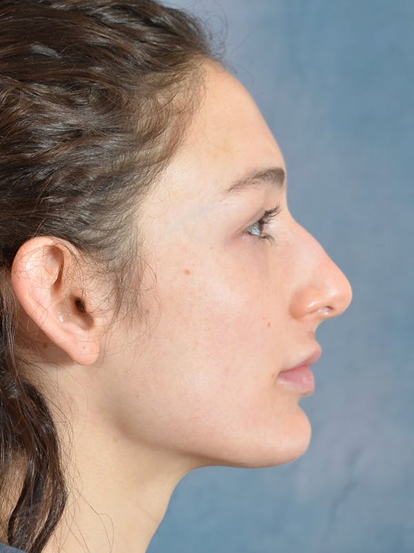 Rhinoplasty Before & After Gallery - Patient 148257069 - Image 7