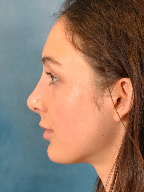 Rhinoplasty Before & After Gallery - Patient 148257069 - Image 2