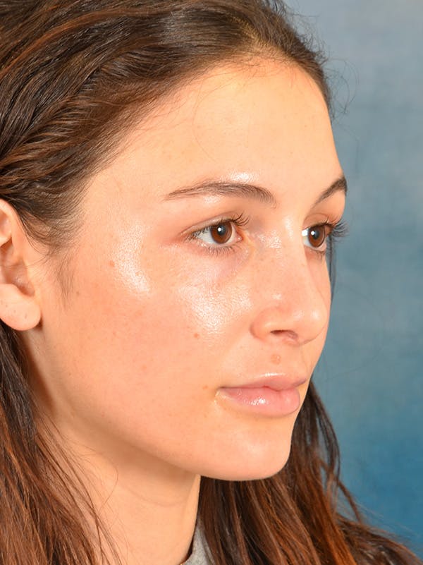 Rhinoplasty Before & After Gallery - Patient 148257069 - Image 6